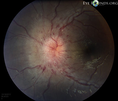 Idiopathic Intracranial Hypertension