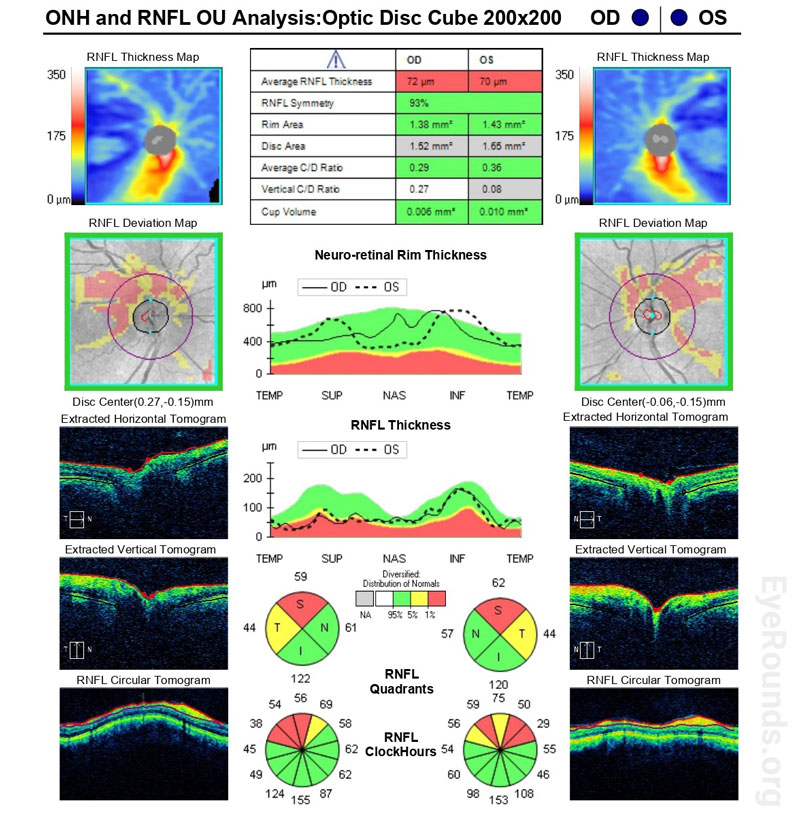  OCT of the optic nerves showed bilateral superior RNFL bundle loss
