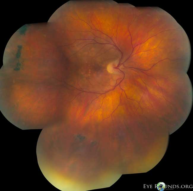 Situs Inversus of the Retinal Vessels