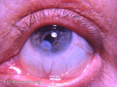 Leukoma: adherent leukoma. EyeRounds.org: Online Ophthalmic Atlas
