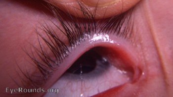 Congenital absence of the lacrimal puncta associated with alacrima and aptyalism OU