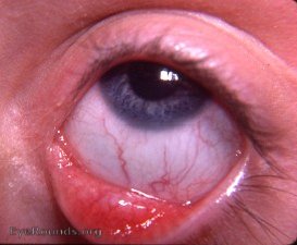 Congenital absence of the lacrimal puncta associated with alacrima and aptyalism OU