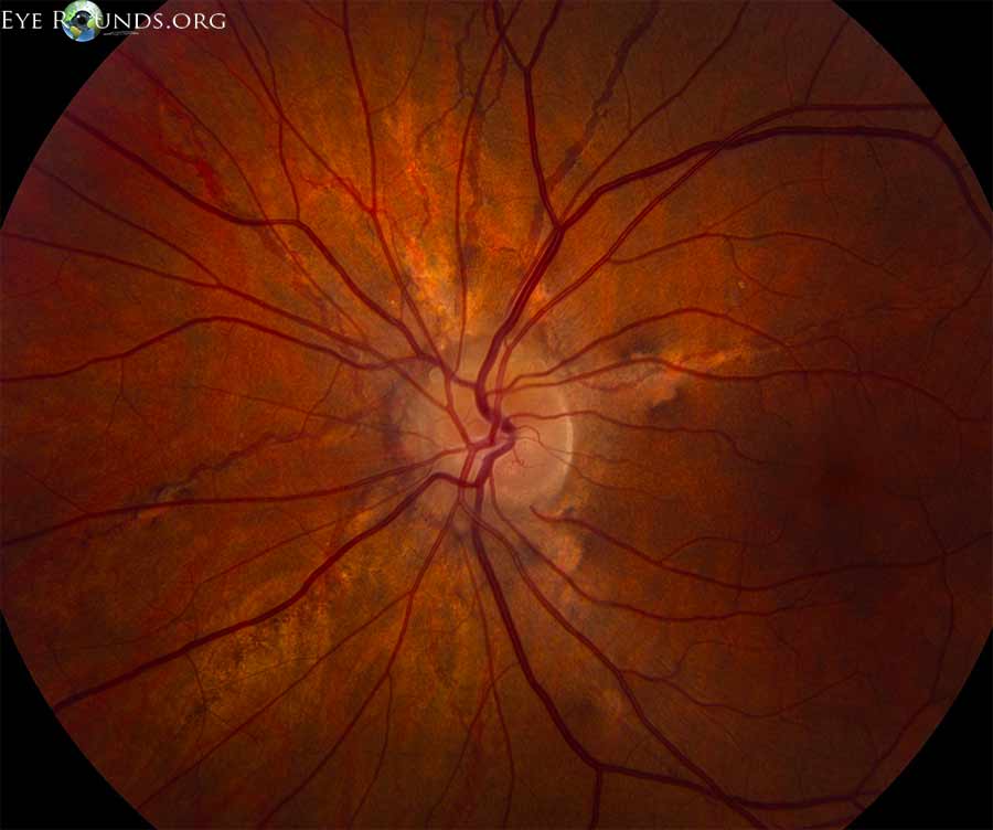 Atlas Entry - Angioid Streaks and Optic Disc Drusen in Pseudoxanthoma ...