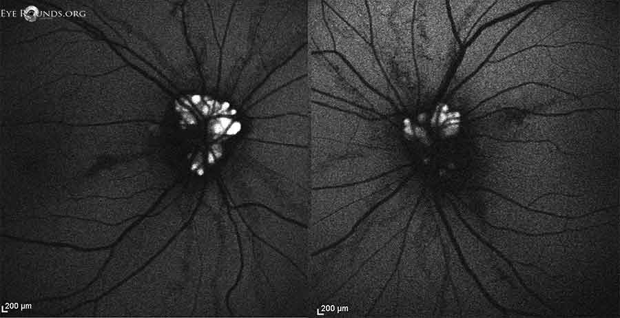 Autofluorescence, both eyes. Areas of increased autofluorescence at the nerve corresponding to the disc drusen; radial areas of hypo-autofluorescence corresponding to angioid streaks