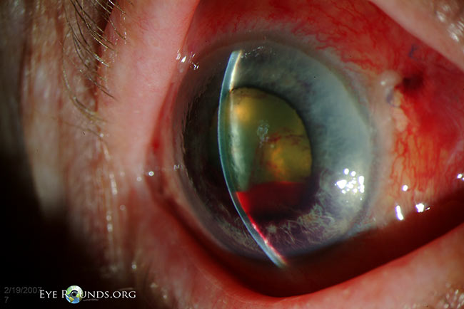 Angle closure glaucoma