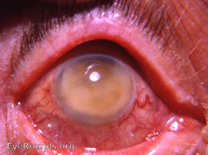 bloodstaining of the cornea 