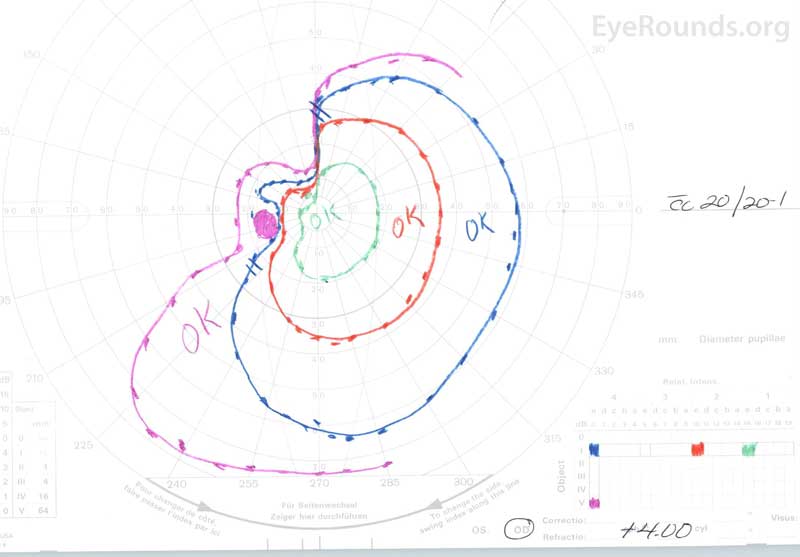 Goldmann visual fields showed a superior greater than inferior temporal defect OS