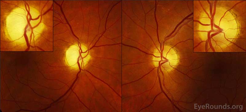 Dilated funduscopic examination showed severe, diffuse optic atrophy OD and bow-tie (band) optic atrophy OS