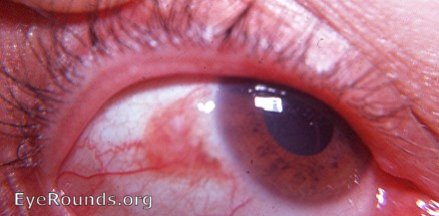 Bowen's disease invading cornea at 9:00 o'clock OD