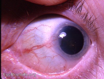 Bowen's disease invading cornea at 9:00 o'clock OD