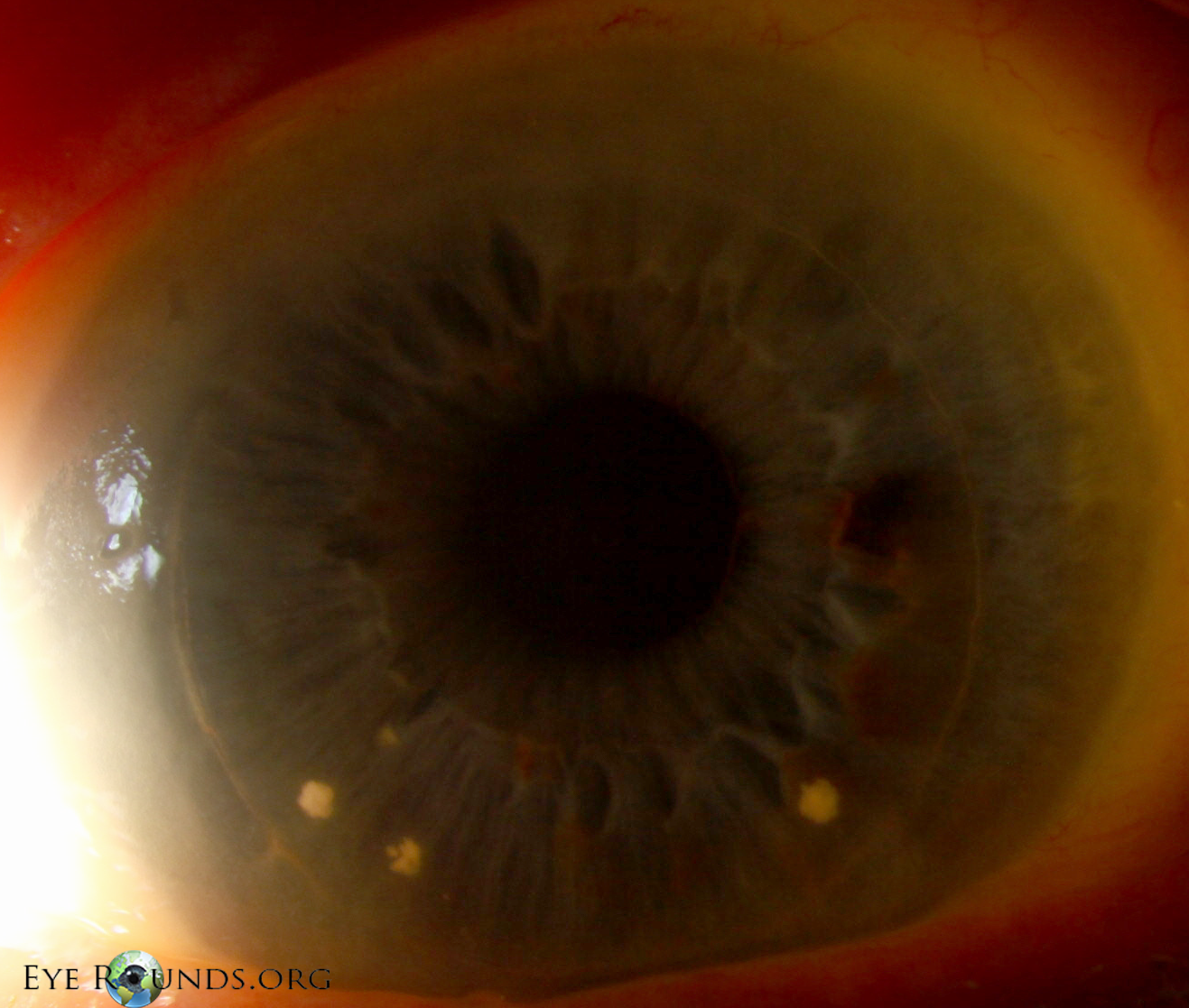 Candida at grat-host interface