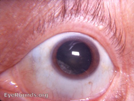 cataract: most common site of an incipient cataract