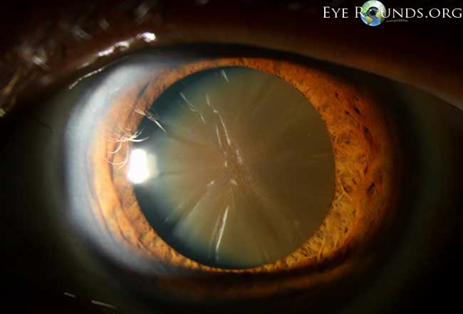 what type of cataract is this?