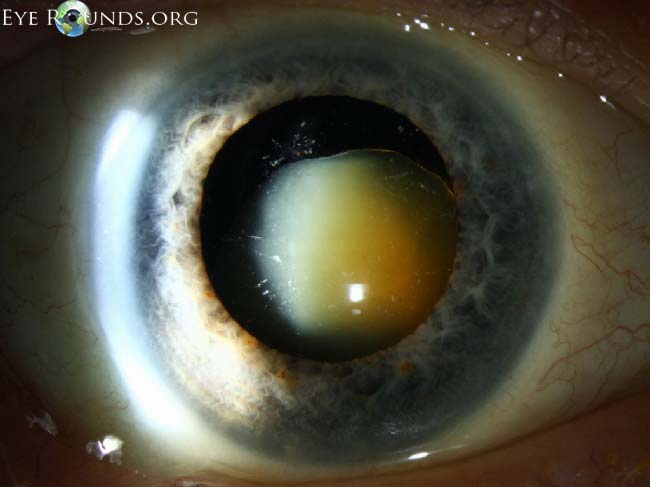 Branch Retinal Artery Occlusion