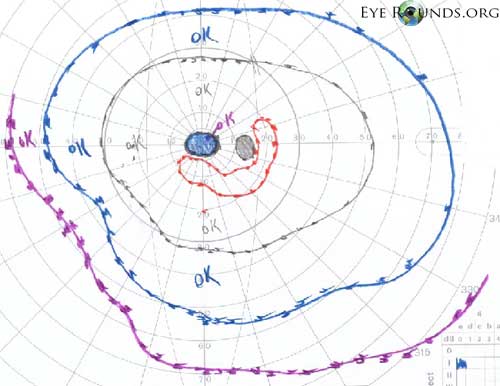 Goldmann Visual Fields