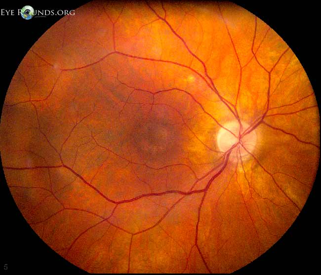 Conre-rod dystrophy, right eye