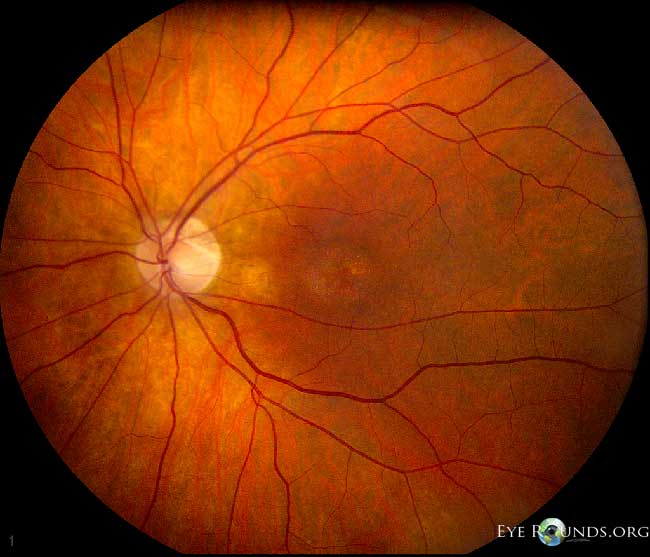 Conre-rod dystrophy, left eye