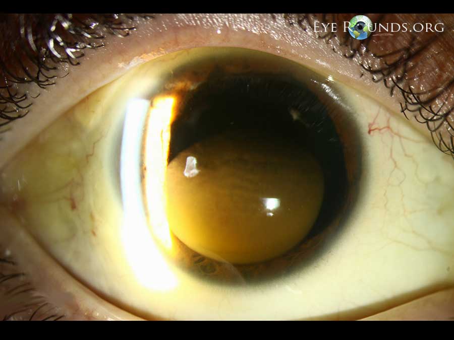 Persistent pupillary membrane