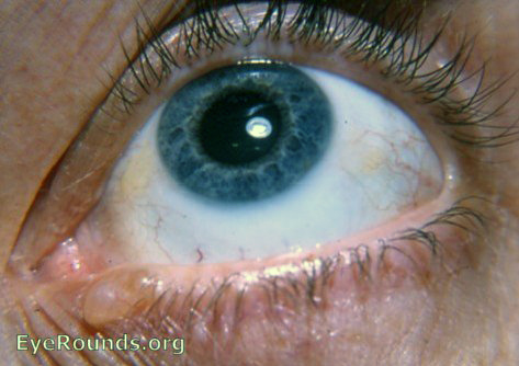 lid margin cyst of ciliary gland of Moll