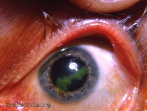 dendritic keratitis: after being scrubbed with ether on a q-tip