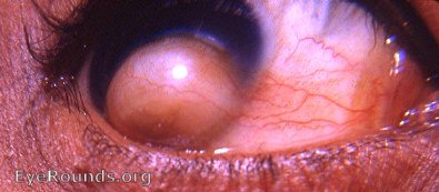 dermoid tumor of cornea