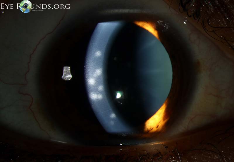 slit lamp showing scattered subepithelial infiltrates involving the visual axis