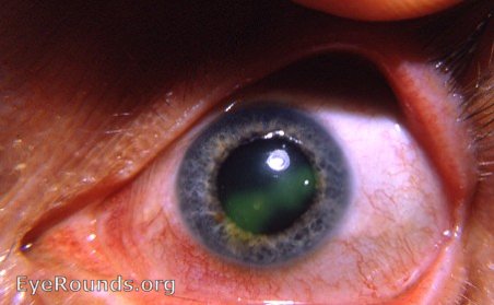 dendritic keratitis: after being scrubbed with ether on a q-tip