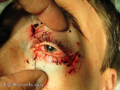 External photos showing periorbital trauma