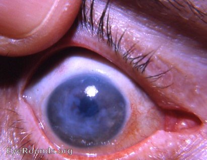 Fuchs' epithelial-endothelial dystrophy of the cornea OD