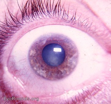 cataract with Fuchs' heterochromic cyclitis