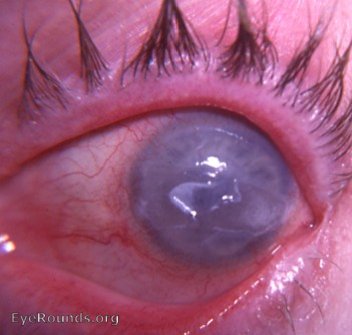 Fuchs epithelial-endothelial corneal dystrophy with central ruptured epithelial bullae