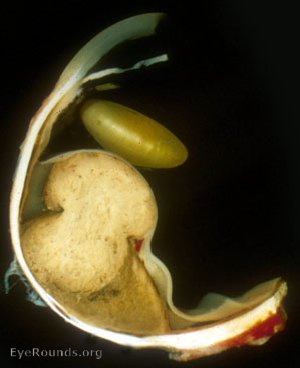 Malignant melanoma of the choroid - mushroom shaped configuration