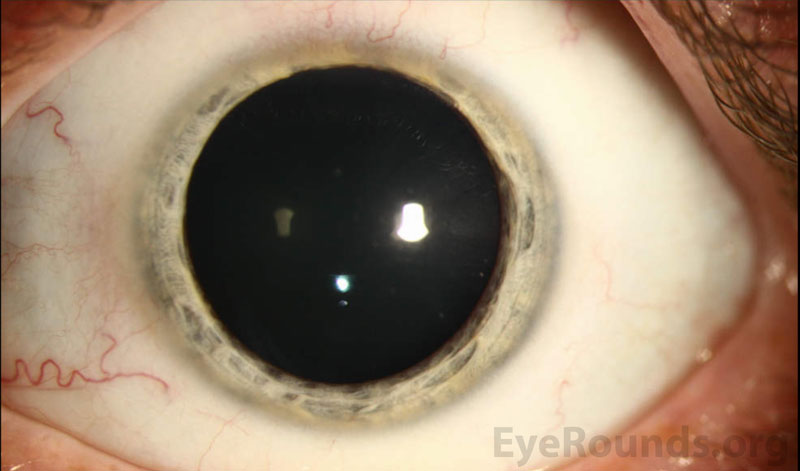 rust-colored anterior subcapsular deposits siderosis bulbi