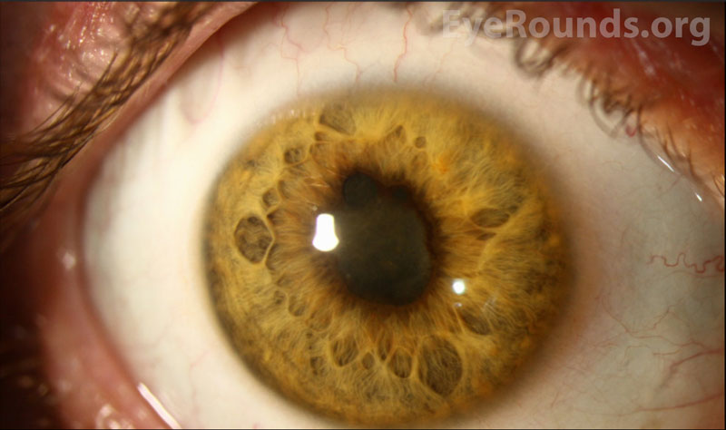 rust-colored anterior subcapsular deposits siderosis bulbi slit lamp