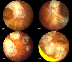 Marshall Syndrome