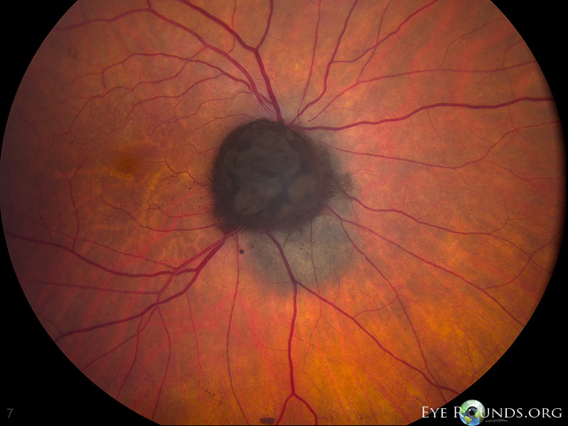 Figure 6b: Melanocytoma with associated choroidal nevus