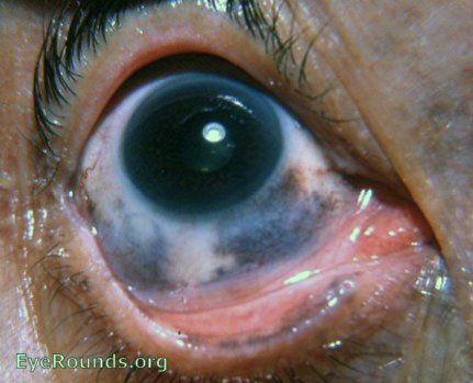 melanosis oculi wih pigmentation of tarsal conjunctiva near lid margin