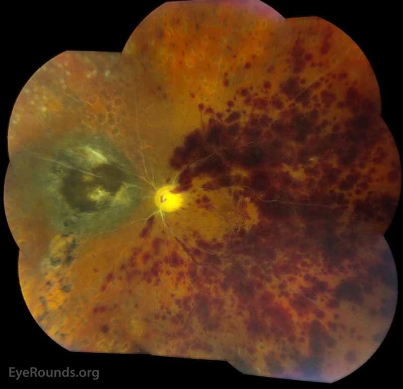 Color fundus photographs, left eye, 5 weeks after combined CRAO/CRVO. Nasal to the optic nerve, there was a 9 x 7.0 x 1.5 mm elevated, moderately pigmented choroidal lesion with overlying coarse pigmentary changes and drusen. There were panretinal photocoagulation scars in the nasal and superior periphery with persistent, extensive retinal hemorrhages throughout the macula and in the mid-periphery superiorly, temporally, and inferiorly. There was severe, diffuse disc pallor OS with peripapillary hemorrhages temporally and severely sclerotic vessels.