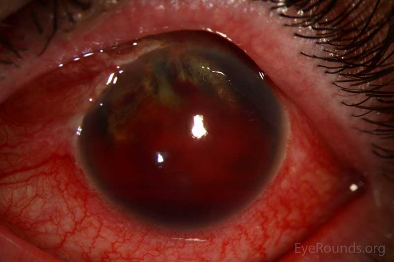 49-year-old male was slapped in the face and a finger went into his left eye rupturing his globe at the superonasal limbus with iris prolapse through the wound. This slit-lamp photograph (top) demonstrates disruption of his anterior segment anatomy with iridodialysis and hyphema.