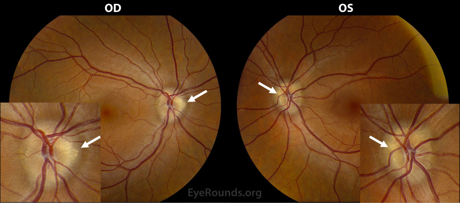 Optic Disc Drusen. Online Ophthalmic Atlas