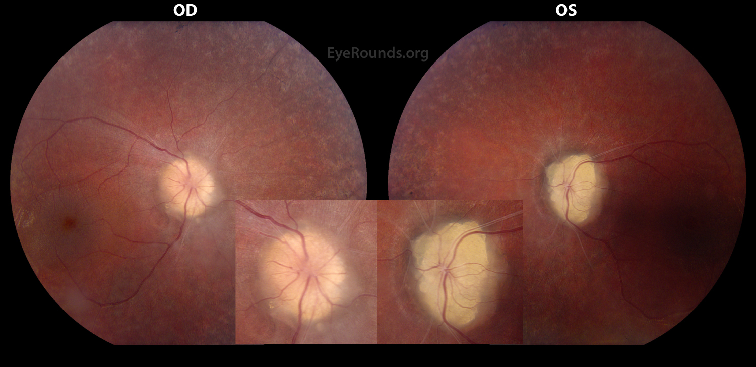 Optic Disc Drusen. Online Ophthalmic Atlas