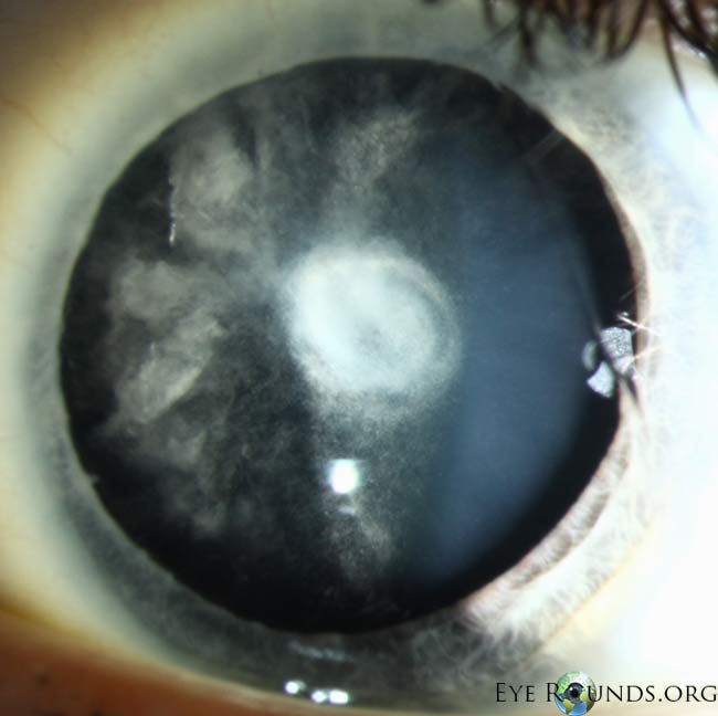 Dominant optic atrophy (Kjer syndrome)