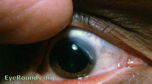 sclerosing keratitis with calcification-inactive