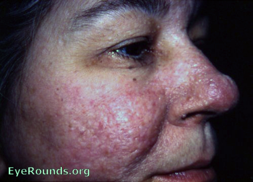 Pringle's Disease ( adenoma sebaceum ) in patient with tuberose ( tuberous ) sclerosis ( Bourneville's Disease )