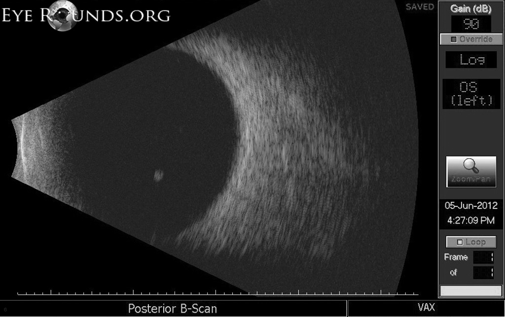 [WUltracound, B-Scan, Vitreous Cyst