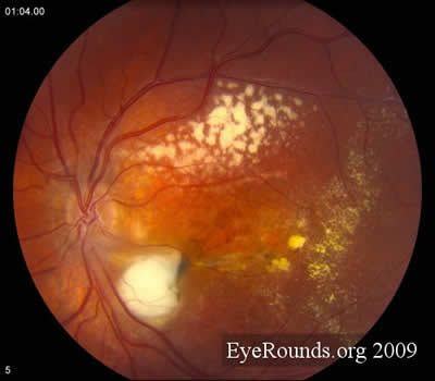 Figure 1 A, color fundus photo