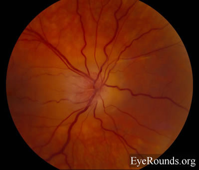 idiopathic recurrent neuroretinitis, leber's stellate neuroretinitis, bartonella henslae, cat-scratch disease, macular star