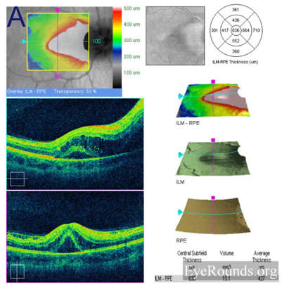 idiopathic recurrent neuroretinitis, leber's stellate neuroretinitis, bartonella henslae, cat-scratch disease, macular star