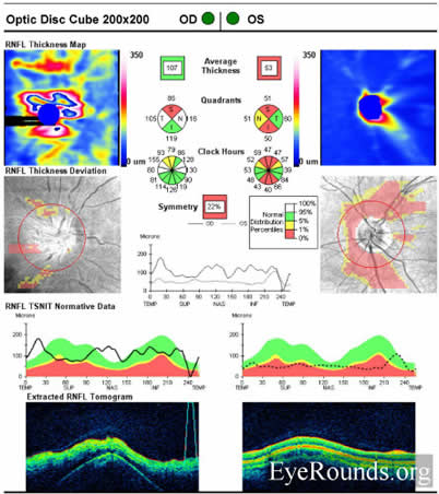 idiopathic recurrent neuroretinitis, leber's stellate neuroretinitis, bartonella henslae, cat-scratch disease, macular star