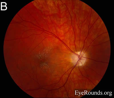 idiopathic recurrent neuroretinitis, leber's stellate neuroretinitis, bartonella henslae, cat-scratch disease, macular star